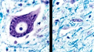 Proteínas no sangue podem prever o surgimento da ELA anos antes dos primeiros sintomas; entenda